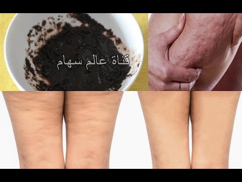 تخلصي من السيلوليت و الخطوط البيضاء نهائيًا في 5 دقائق