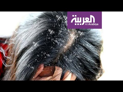 شاهد الحل النهائي للتخلص من قشرة الرأس من دون معاناة