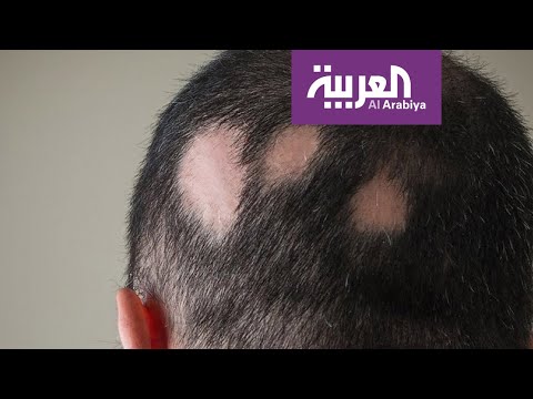 شاهد تعرّف على أسباب وأعراض الثعلبة وعلاجاتها